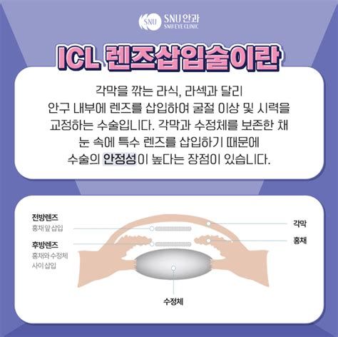 난시 라식