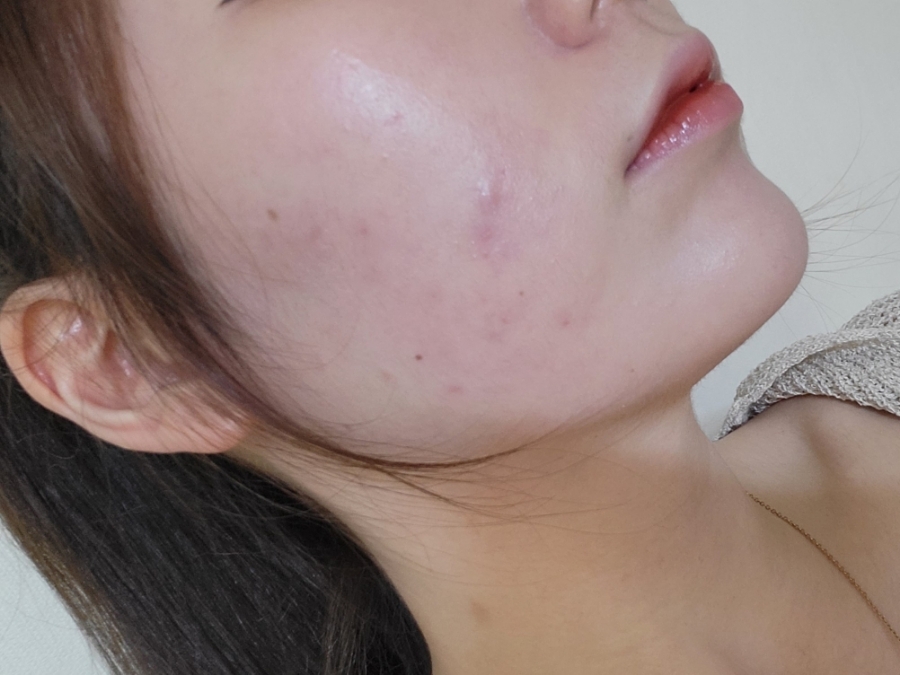 bbl 레이저 후기