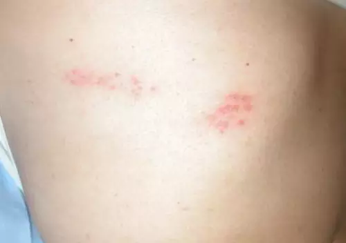 대상포진-초기증상-원인-건강