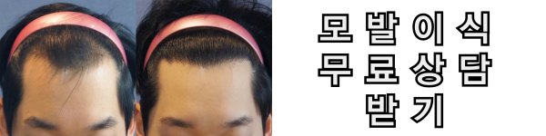 모발이식