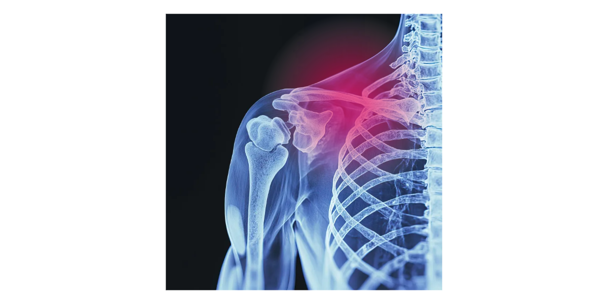 쇄골통증, 흉곽출구증후군