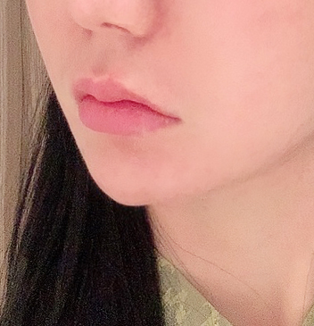 인중 축소 수술 후기