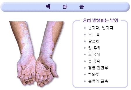 백반증 증상