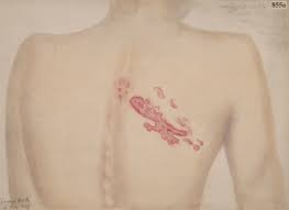 대상포진 초기증상