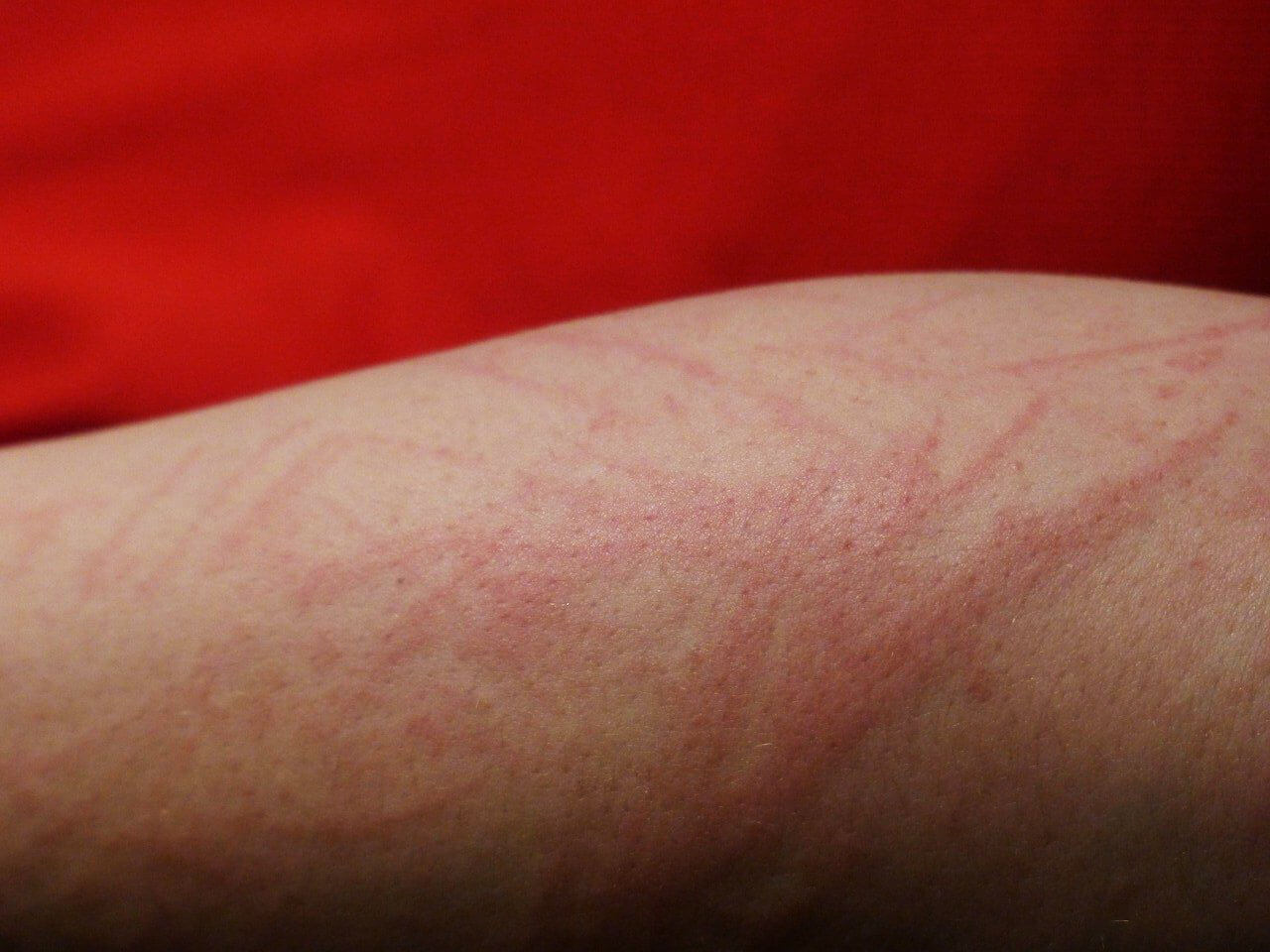 “피부-두드러기-증상”