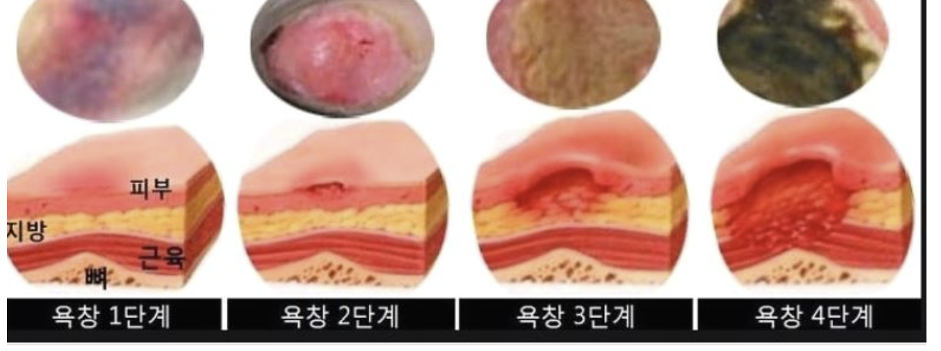 알기쉬운 단계별 욕창 구분법