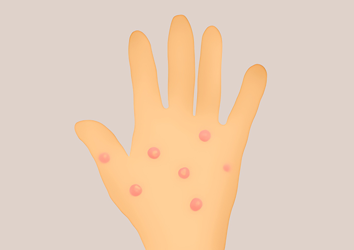 발진이-심한-손