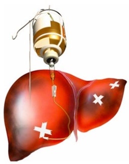 간의 치료를 형상화한 그림