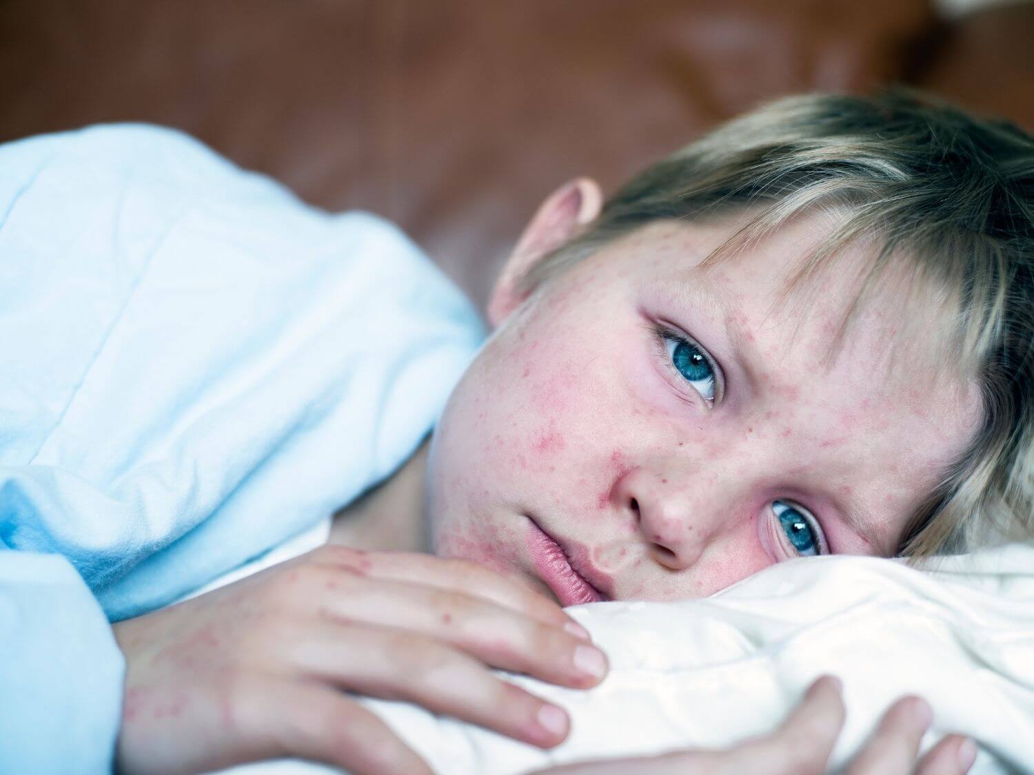 뇌전증 원인 풍진