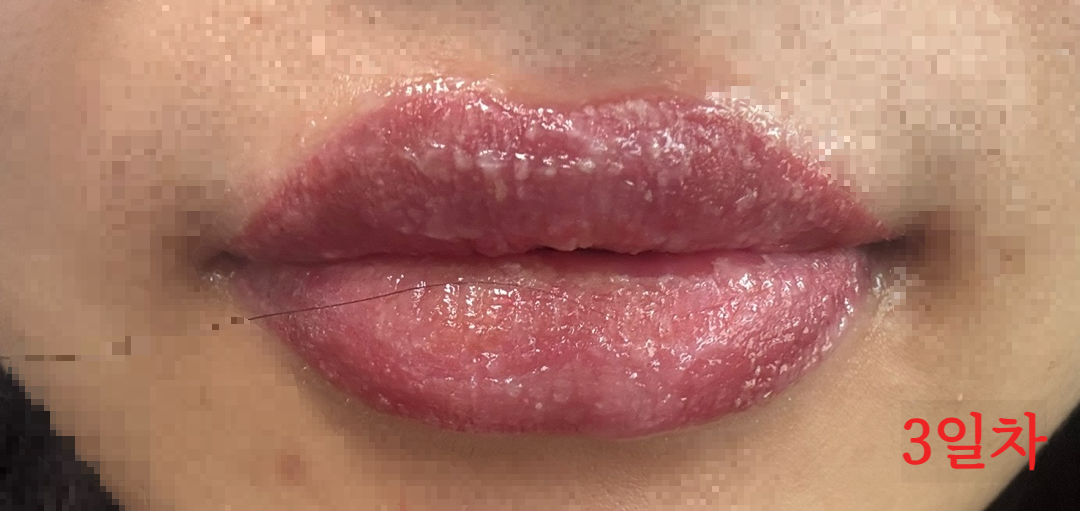 립타투 3일차 – 입술이 따끔거리고 전체적으로 부풀어 있는 상태