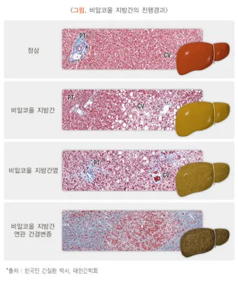 비알콜성 지방간 없애는 방법 운동 식단 중심 회복법 정리_21