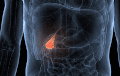 담낭염의 증상, 담낭 용종