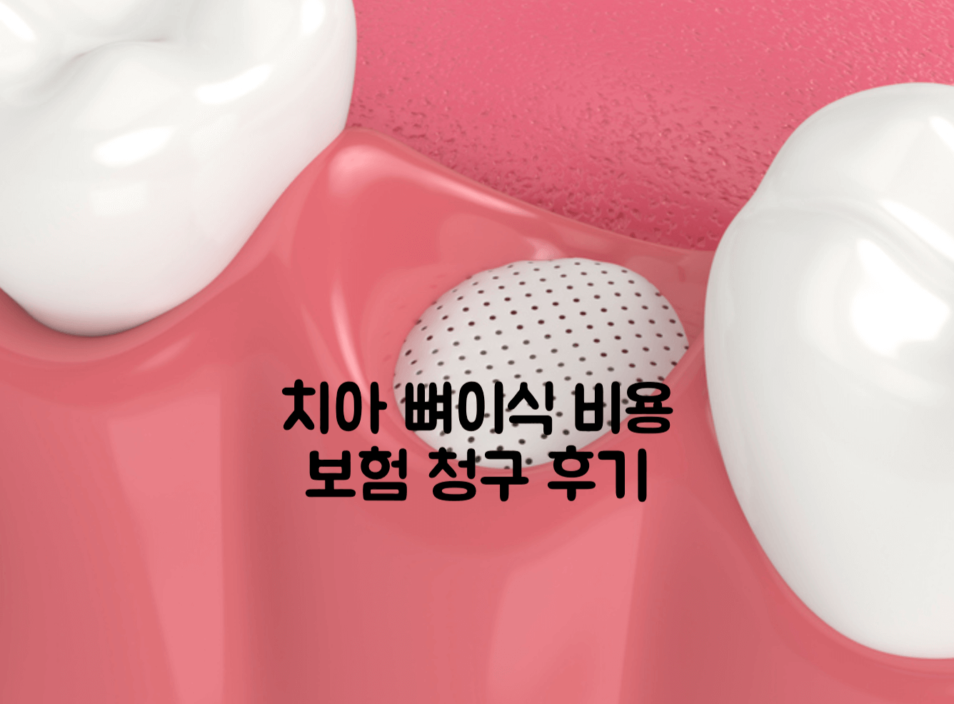 치아 뼈이식 비용