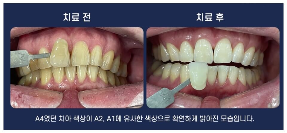 치아미백 치료