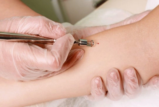 피부암 종류별 초기증상 10가지