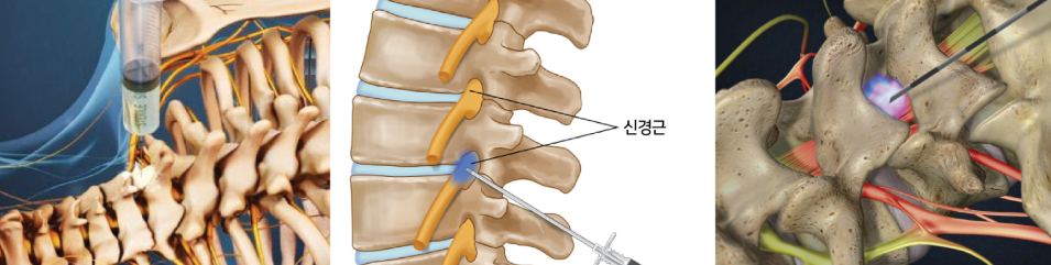 배부신경 차단술2