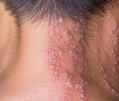 2024년 대상포진 무료 접종 지자체 리스트와 신청방법