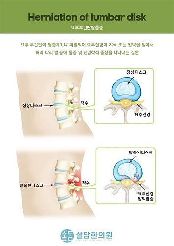 디스크