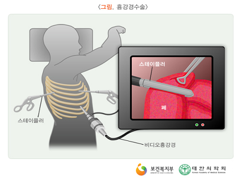 기흉 관련 수술