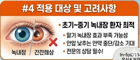 녹내장 수술