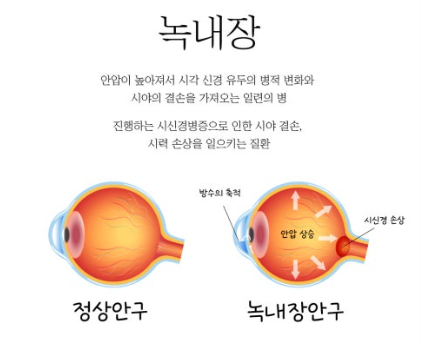 녹내장 관련 사진