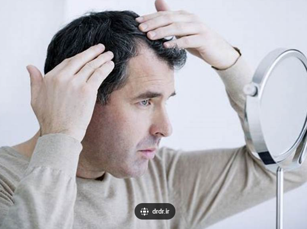 탈모 2