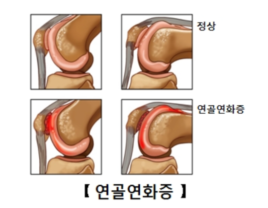 연골연화증, 무릎 통증의 주범! 이렇게 예방하고 치료하세요