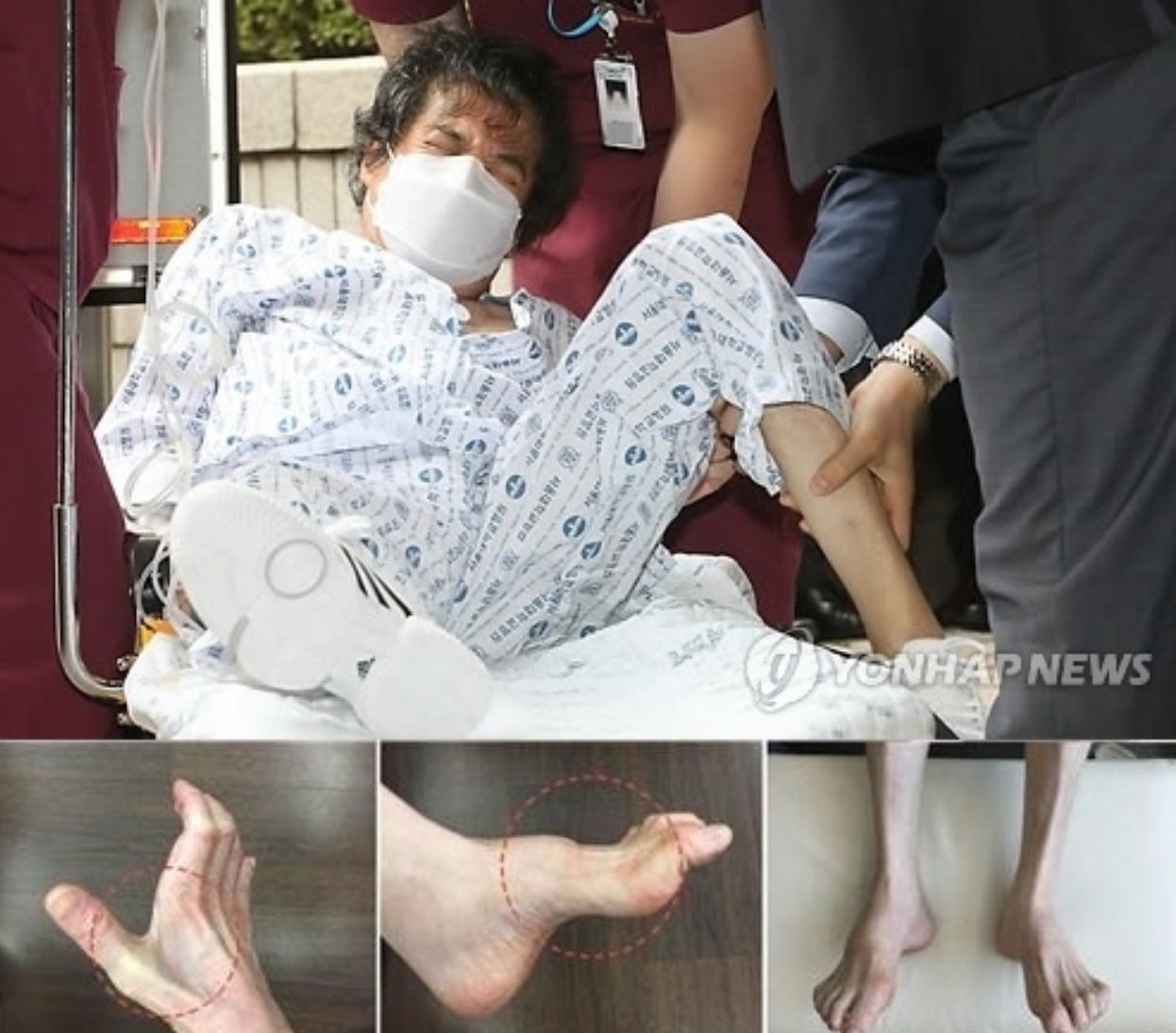 삼성가 이부진 사장 걸음걸이와 샤르코 마리 투스 유전병 팩트체크