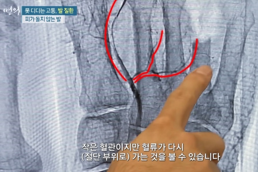 당뇨발-명의-천동일