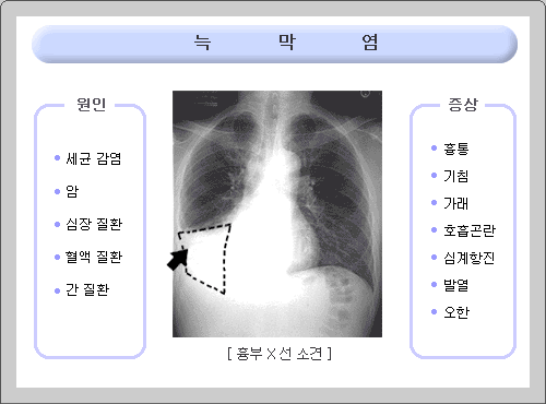 호흡기 질환: 늑막염- 원인, 증상, 치료방법, 진단방법, 후유증.
