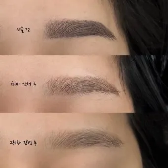 눈썹 문신 제거 방법 꿀팁_4