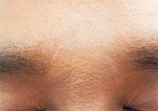 미간주름 자가진피재생술 후