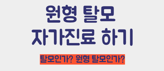 원형탈모 자가진료하기