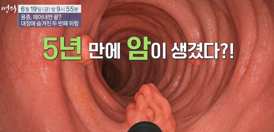 대장에숨겨진두번째위험