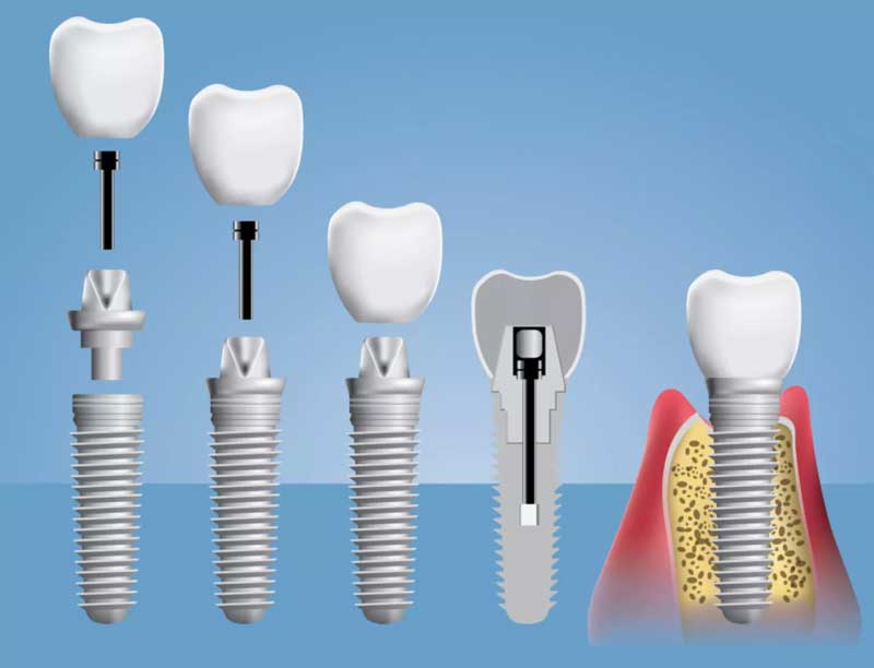 임플란트 단계별 과정 이미지