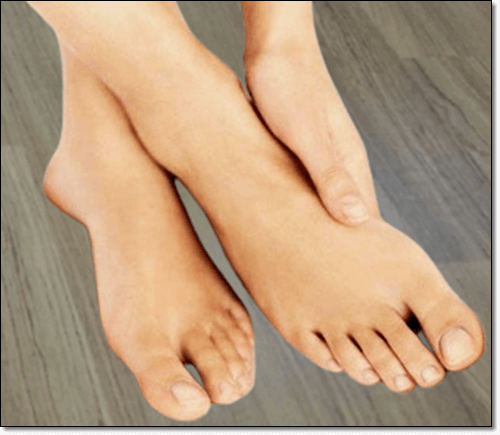통풍 환자 