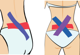 허리 디스크(추간판 탈출증)일 때