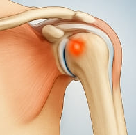 어깨 석회질 치료방법