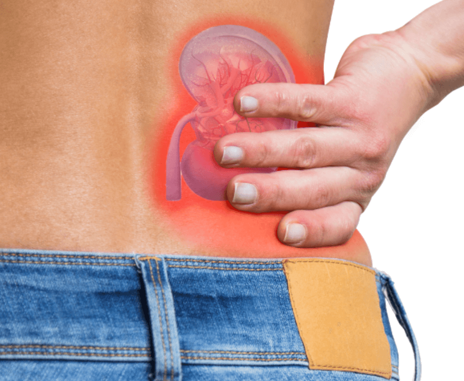 오른족 옆구리 통증 신장결석