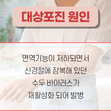 대상포진 원인