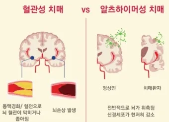 혈관성치매 원인 증상 치료법과 예방 생활습관_22