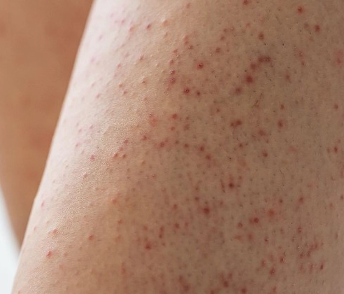 모공각화증 치료 방법 7가지 및 모공각화증 로션 미스트 추천 (+자주묻는질문)