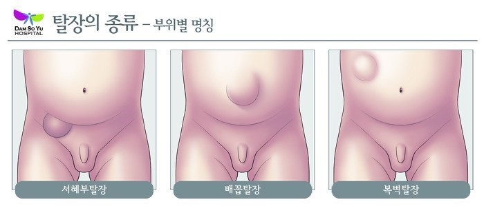 서혜부 탈장