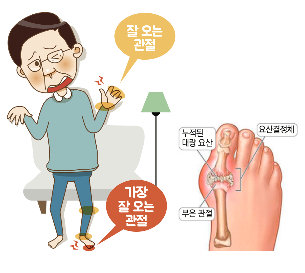 통풍-통풍원인-통풍증상