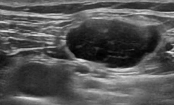 림프종 초음파 영상