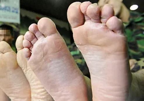 athlete-foot-symptoms-stages-characteristics-and-treatment