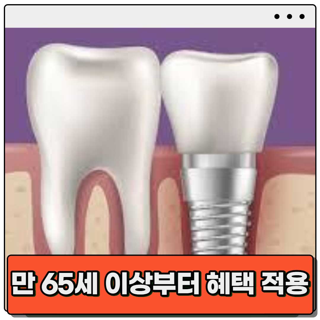 임플란트-의료보험-적용-나이-만-65세-이상-혜택