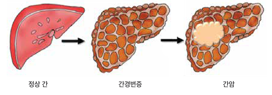 비만으로 간암까지? 술 안 마셔도 위험합니다