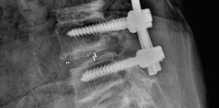 척추융합수술을 받은 척추 사진