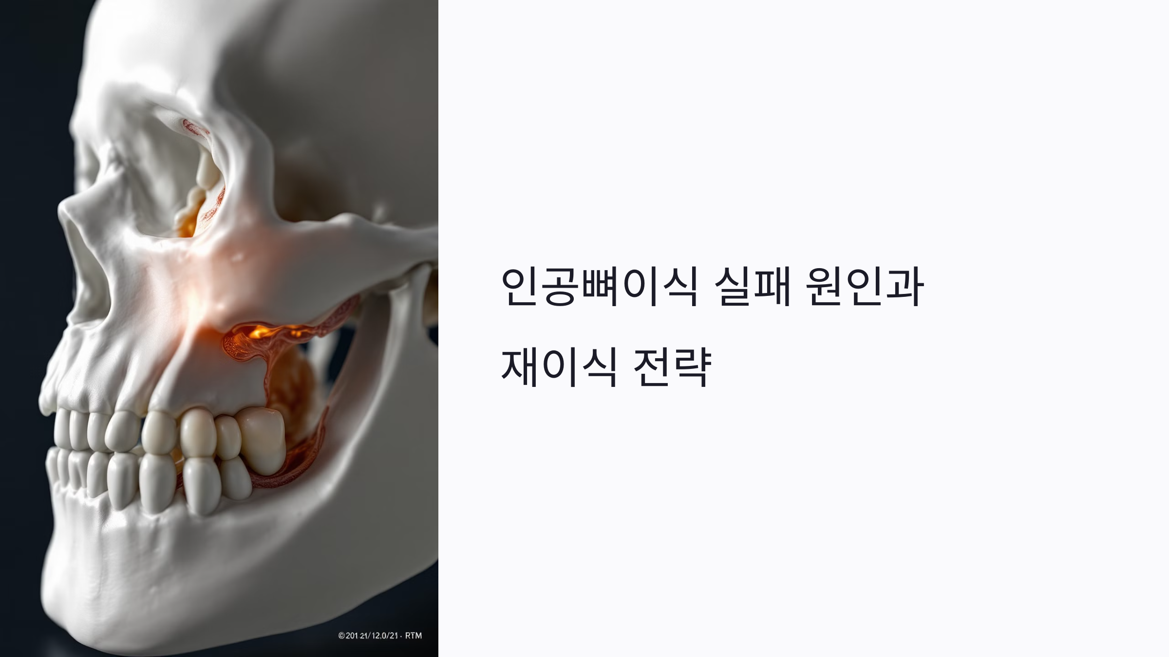 인공뼈이식 실패 이유는? 재이식 전 준비부터 비용까지 분석